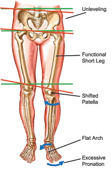 York Region custom orthotics - Effect of overpronation on posture