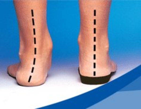 Custom Orthotics - Overpronation Correction