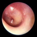 Acute_Otitis_Media