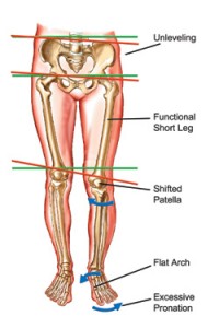 overpronation causing posture change